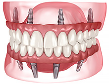 и еще одна картинка с зубными имплантами